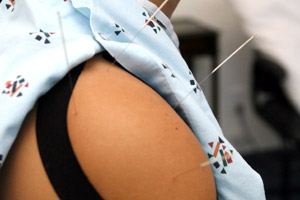 Woman receiving acupuncture in Valencia
